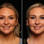 LuxeLift Before and After Photos in Cincinnati, OH, Patient 14462
