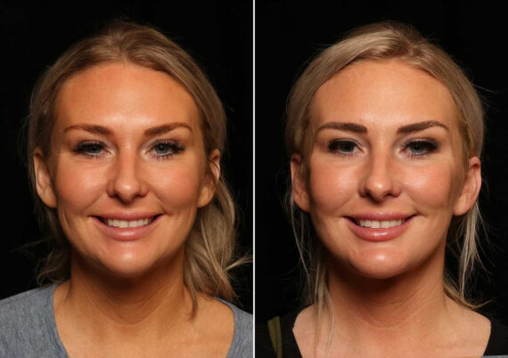 LuxeLift Before and After Photos in Cincinnati, OH, Patient 14462