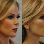 Blepharoplasty Before and After Photos in Cincinnati, OH, Patient 14470