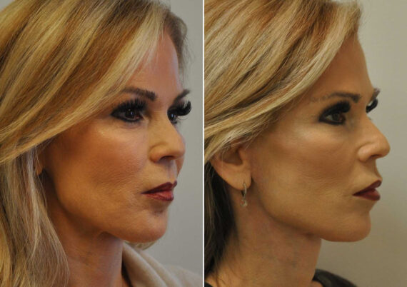 Blepharoplasty Before and After Photos in Cincinnati, OH, Patient 14470