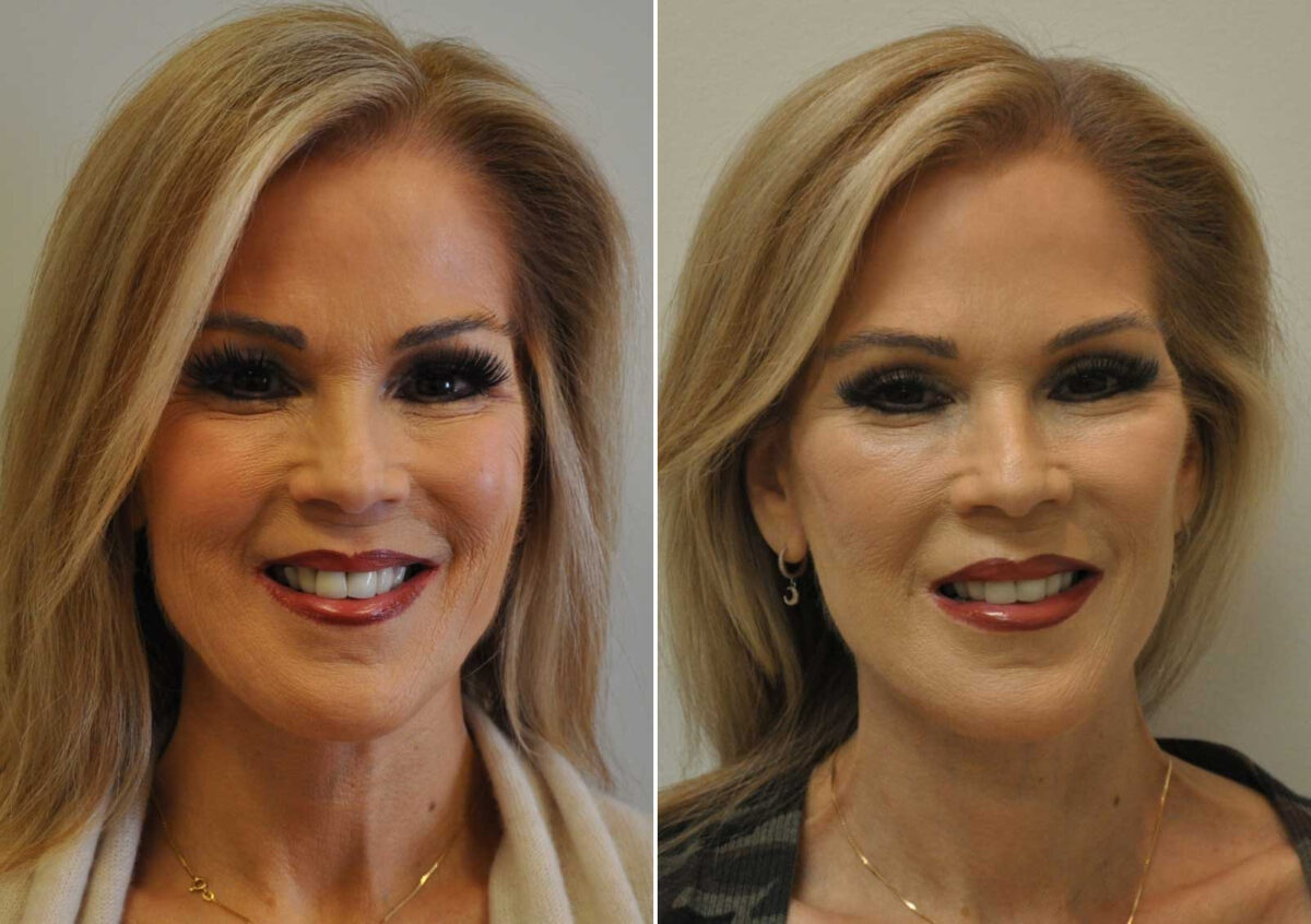 Blepharoplasty Before and After Photos in Cincinnati, OH, Patient 14470