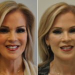 Blepharoplasty Before and After Photos in Cincinnati, OH, Patient 14470