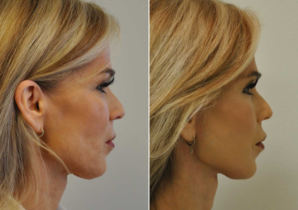 Blepharoplasty Before and After Photos in Cincinnati, OH, Patient 14470