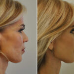 Blepharoplasty Before and After Photos in Cincinnati, OH, Patient 14470