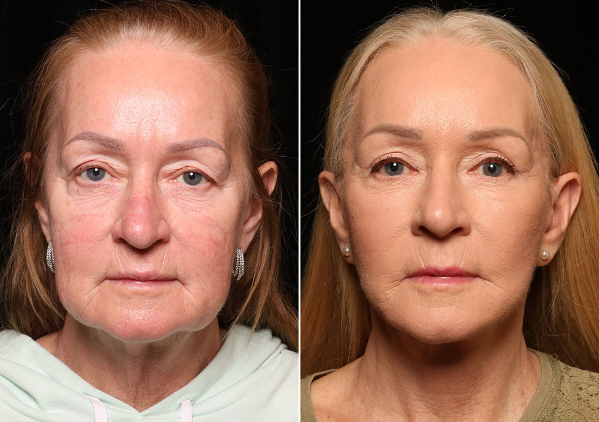 Blepharoplasty Before and After Photos in Cincinnati, OH, Patient 14480