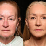 Blepharoplasty Before and After Photos in Cincinnati, OH, Patient 14480