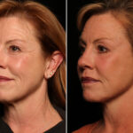 Blepharoplasty Before and After Photos in Cincinnati, OH, Patient 14487