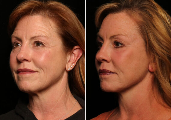 Blepharoplasty Before and After Photos in Cincinnati, OH, Patient 14487