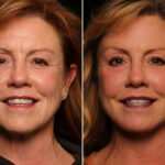 Blepharoplasty Before and After Photos in Cincinnati, OH, Patient 14487