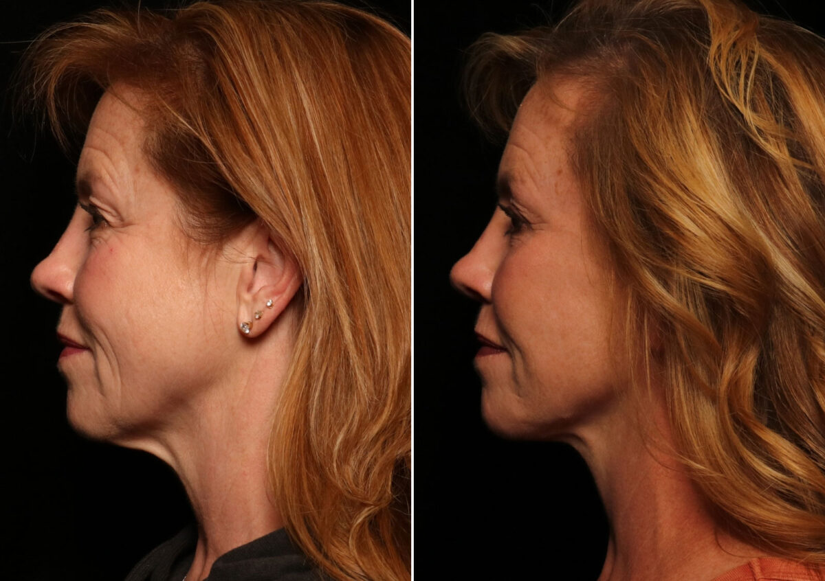 Blepharoplasty Before and After Photos in Cincinnati, OH, Patient 14487