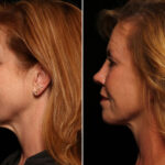 Blepharoplasty Before and After Photos in Cincinnati, OH, Patient 14487