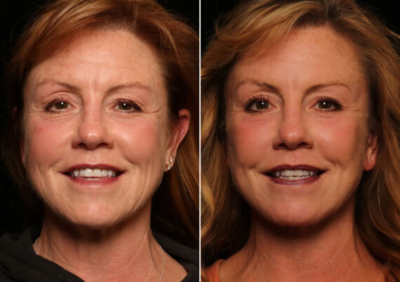 LuxeLift Before and After Photos in Cincinnati, OH