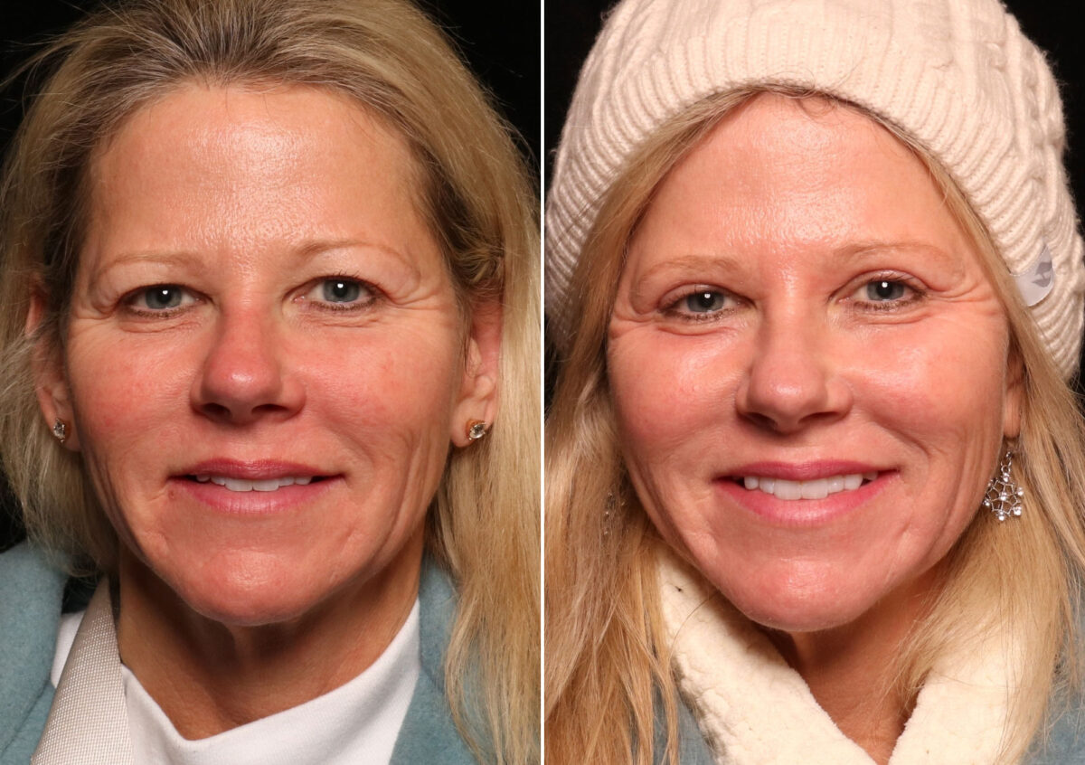 Blepharoplasty Before and After Photos in Cincinnati, OH, Patient 14497