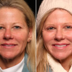 Blepharoplasty Before and After Photos in Cincinnati, OH, Patient 14497