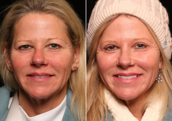 Blepharoplasty Before and After Photos in Cincinnati, OH