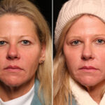 Blepharoplasty Before and After Photos in Cincinnati, OH, Patient 14497