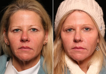 Blepharoplasty Before and After Photos in Cincinnati, OH, Patient 14497