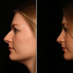Rhinoplasty (Nose Reshaping) Before and After Photos in Cincinnati, OH, Patient 14504