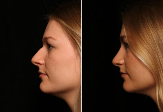 Rhinoplasty (Nose Reshaping) Before and After Photos in Cincinnati, OH, Patient 14504