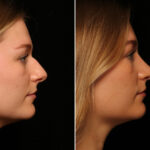 Rhinoplasty (Nose Reshaping) Before and After Photos in Cincinnati, OH, Patient 14504