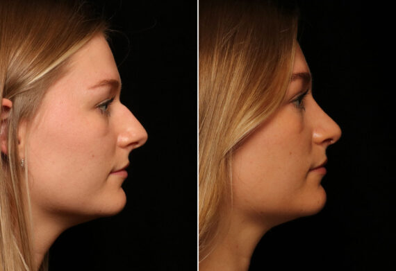 Rhinoplasty (Nose Reshaping) Before and After Photos in Cincinnati, OH, Patient 14504
