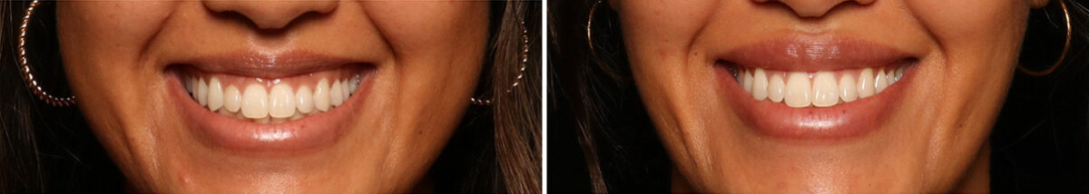 Lip Filler Before and After Photos in Cincinnati, OH, Patient 16147