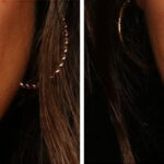 Lip Filler Before and After Photos in Cincinnati, OH, Patient 16147