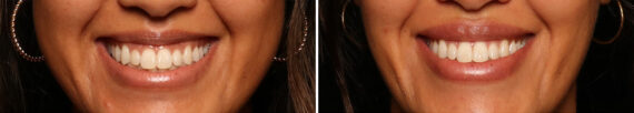 Lip Filler Before and After Photos in Cincinnati, OH