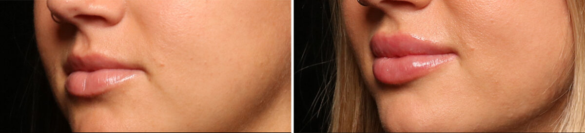 Lip Filler Before and After Photos in Cincinnati, OH, Patient 16178