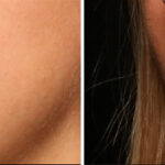 Lip Filler Before and After Photos in Cincinnati, OH, Patient 16178