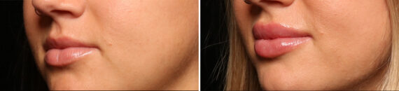 Lip Filler Before and After Photos in Cincinnati, OH, Patient 16178