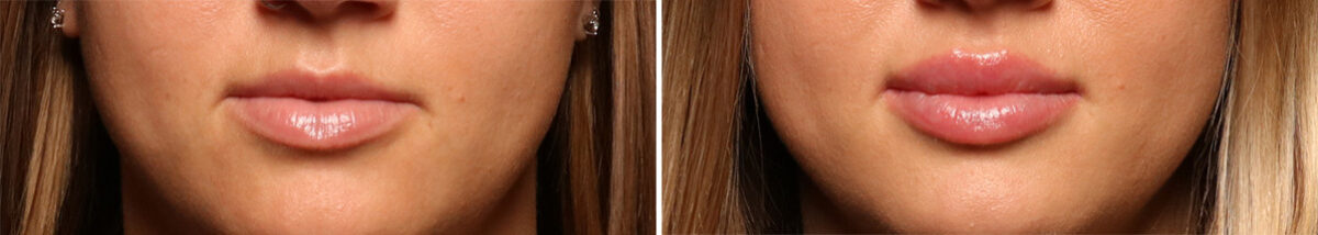 Lip Filler Before and After Photos in Cincinnati, OH, Patient 16178