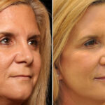 Lip Filler Before and After Photos in Cincinnati, OH, Patient 16182