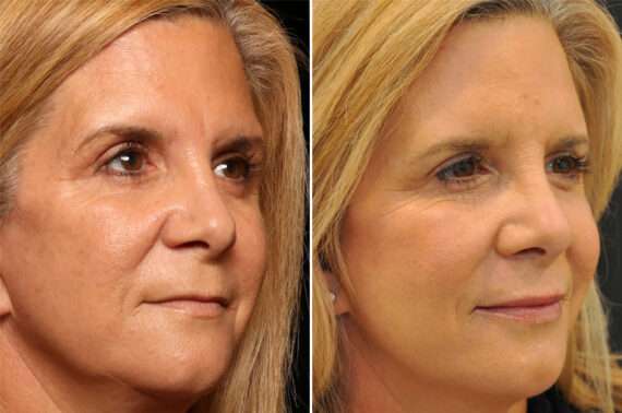 Lip Filler Before and After Photos in Cincinnati, OH, Patient 16182