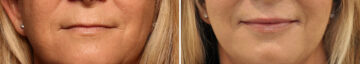 Lip Filler Before and After Photos in Cincinnati, OH, Patient 16182