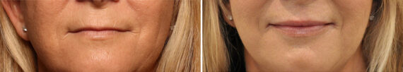 Lip Filler Before and After Photos in Cincinnati, OH, Patient 16182