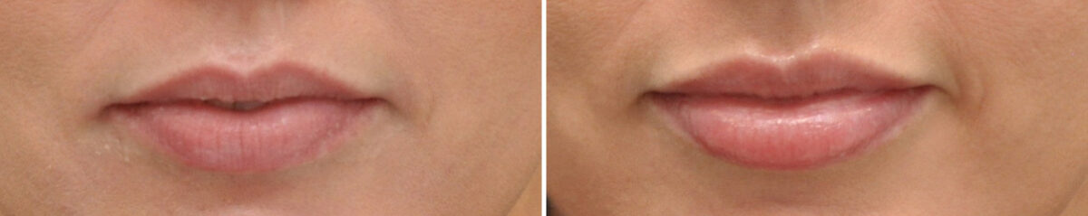 Lip Filler Before and After Photos in Cincinnati, OH, Patient 16186