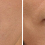 Lip Filler Before and After Photos in Cincinnati, OH, Patient 16186