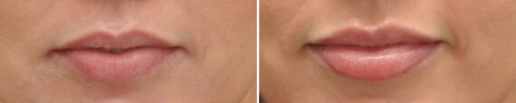 Lip Filler Before and After Photos in Cincinnati, OH, Patient 16186