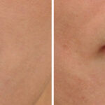 Lip Filler Before and After Photos in Cincinnati, OH, Patient 16186