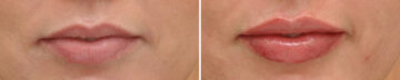 Lip Filler Before and After Photos in Cincinnati, OH, Patient 16186