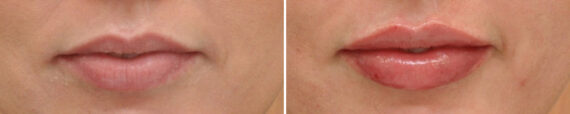 Lip Filler Before and After Photos in Cincinnati, OH, Patient 16186