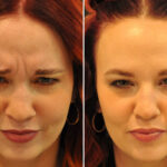 Cosmetic Injectables Before and After Photos in Cincinnati, OH, Patient 16190