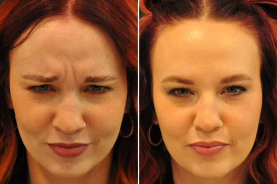 Cosmetic Injectables Before and After Photos in Cincinnati, OH, Patient 16190
