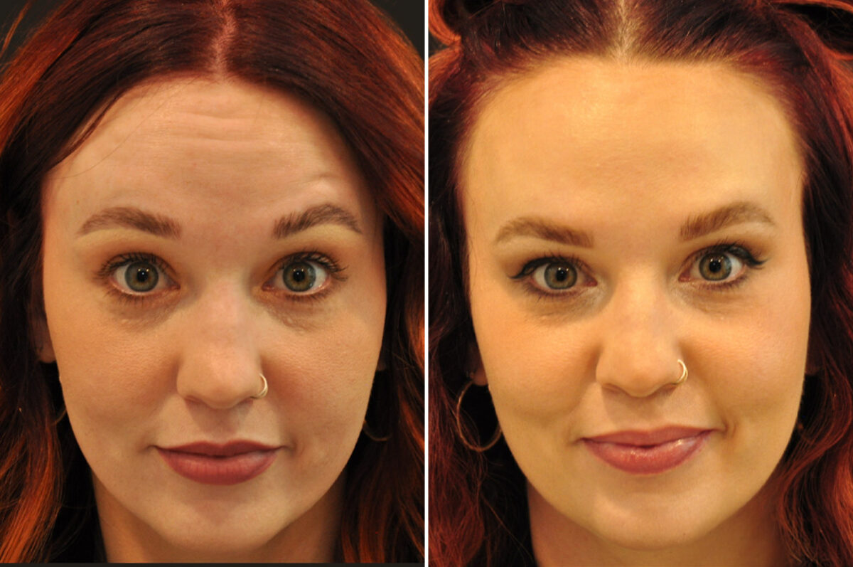 Cosmetic Injectables Before and After Photos in Cincinnati, OH, Patient 16190