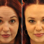 Cosmetic Injectables Before and After Photos in Cincinnati, OH, Patient 16190