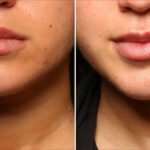 Cosmetic Injectables Before and After Photos in Cincinnati, OH, Patient 16194