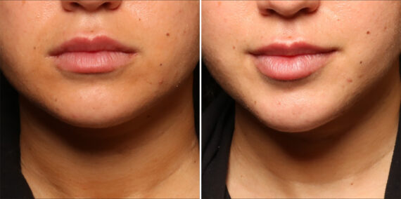Cosmetic Injectables Before and After Photos in Cincinnati, OH, Patient 16194