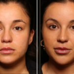 Cosmetic Injectables Before and After Photos in Cincinnati, OH, Patient 16194