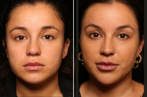 Cosmetic Injectables Before and After Photos in Cincinnati, OH, Patient 16194